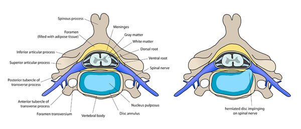 The discal hernication | Jean-Philippe Perreault physical therapist