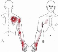 Trigger points and pain in shoulder blade muscles
