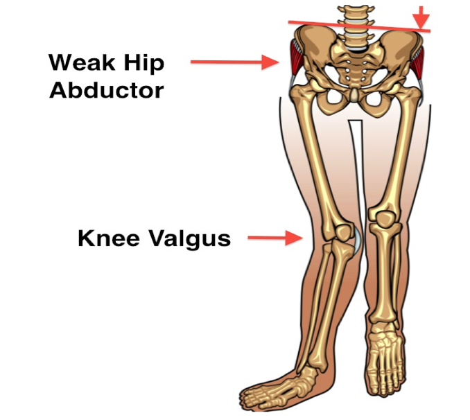 Hip weakness and knee position for knee pain