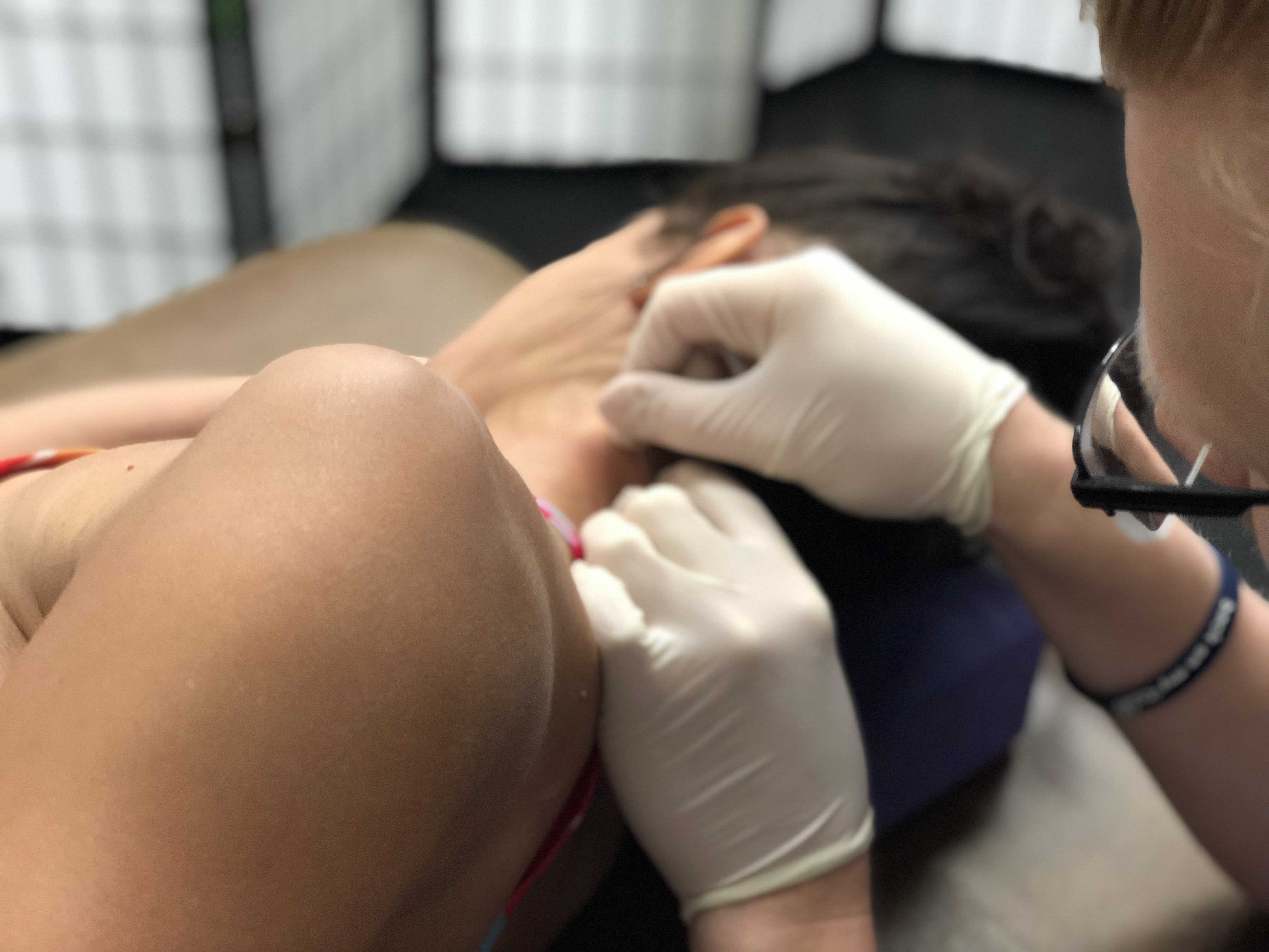 photo of Dry Needling Technique photo of Dry Needling Technique
