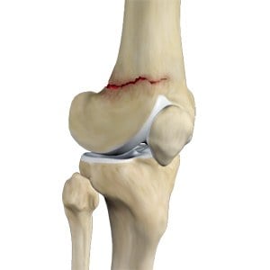 Fracture of the knee bone (femur)