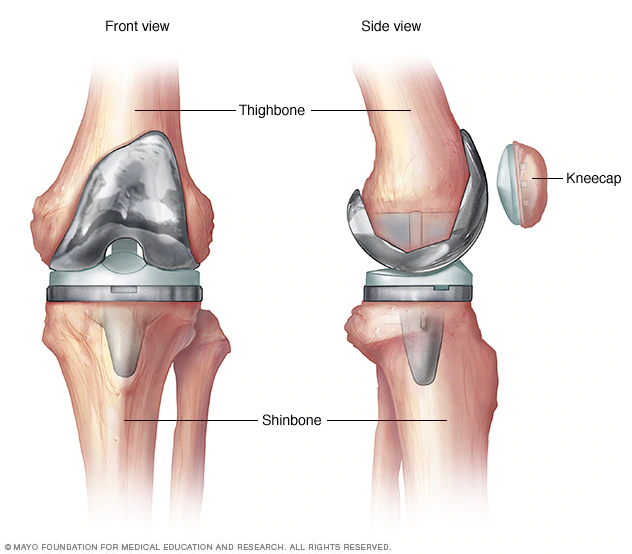 Mayo Clinic's photo of a knee replacement