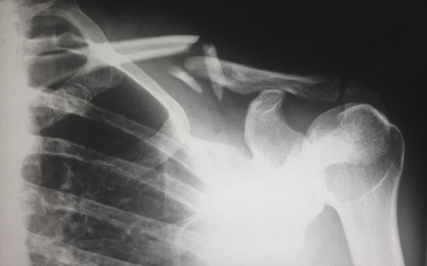 An X-ray (radiograph) of a broken collarbone